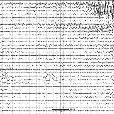 Ten Second Eeg Recording Of The Onset Of A Typical Epileptic Seizure