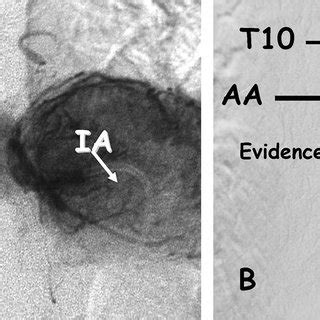 Preoperative Spinal Angiography Of A Posterior Left Neurogenic Tumor