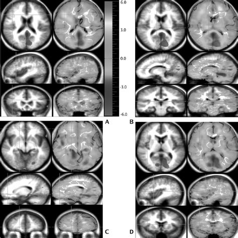 Several Areas Of Higher Regional Cerebral Blood Flow Rcbf In Yellow