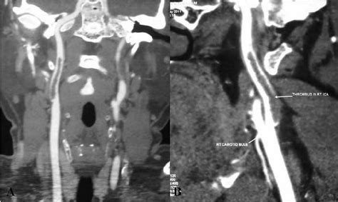 Ct Angiography Of Right Carotid Artery Showing The Fft Extending From Download Scientific