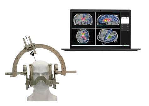 脑立体定向仪 立体定向手术计划系统