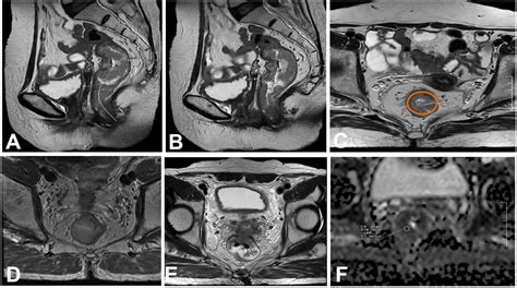 Frontiers Extramural Vascular Invasion Nomogram Before Radical