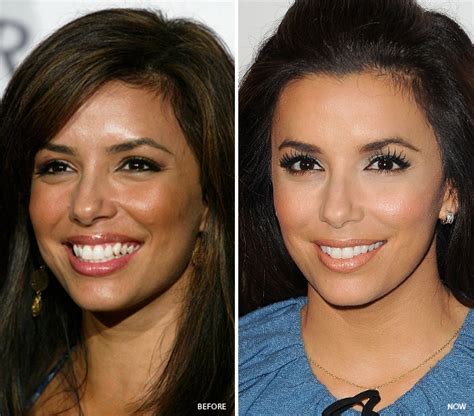 Eva Longoria Plastic Surgery Before And After Facelift Botox Injection