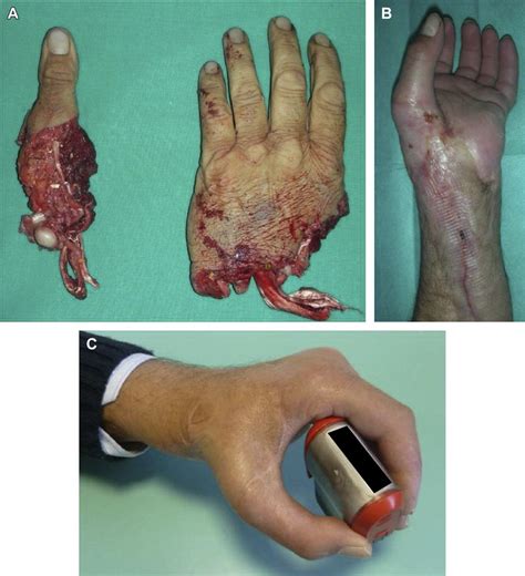 A Amputation Of Multiple Digits B Successful Replantation Of Thumb