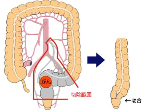 大腸がんの治療 大腸疾患 昭和大学医学部 外科学講座 消化器・一般外科学部門