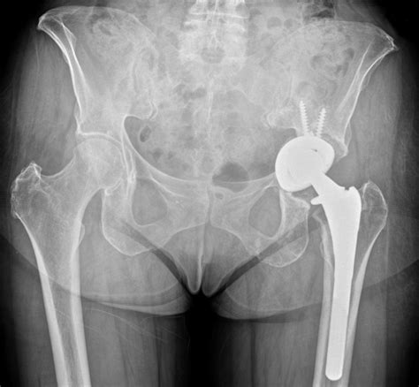 Two Centre Radiological Survivorship Of Acetabular Distraction