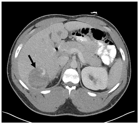 Diagnostics Free Full Text Androgen Induced Catenin Activated