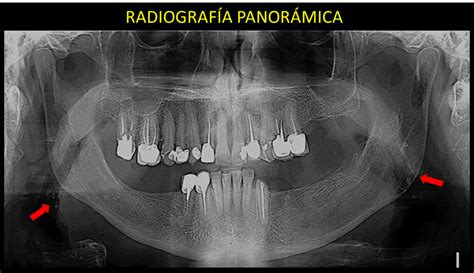 Caso Nº 107 Carcinoma De Seno Maxilar Cdi Perú