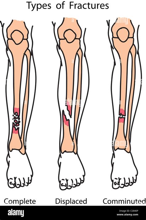 Types Bone Fractures Hi Res Stock Photography And Images Alamy