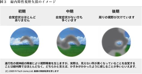 緑内障の予防と治療 | 本当の美しさを求めてーかぐや治療院 - 楽天ブログ