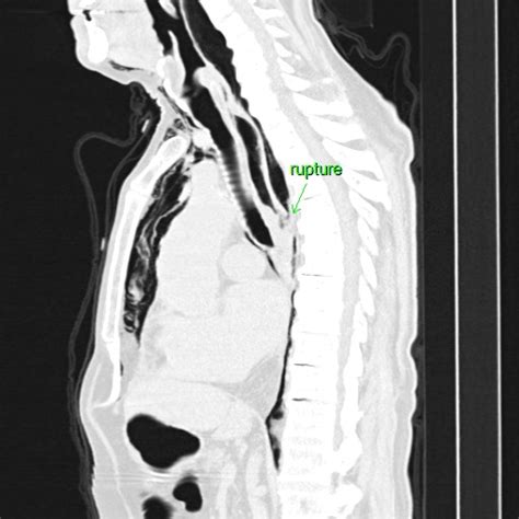 Iatrogenic Esophageal Perforation Image Radiopaedia Org