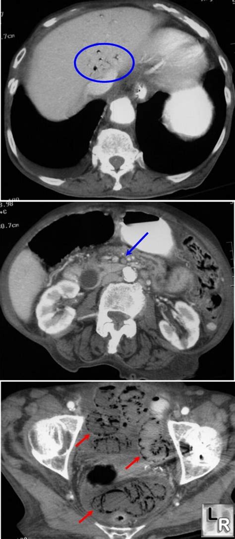 LearningRadiology Mesenteric Ischemia