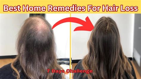 2 Best Natural Home Remedies To Prevent Your Hair Loss Permanently