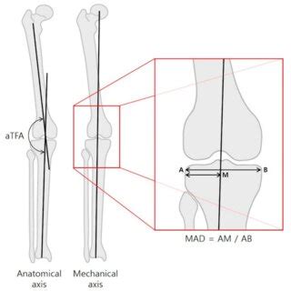 The anatomical tibiofemoral angle (aTFA) was measured on full-length ...