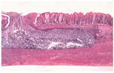 Entamoeba Histolytica Flask Shaped Ulcers