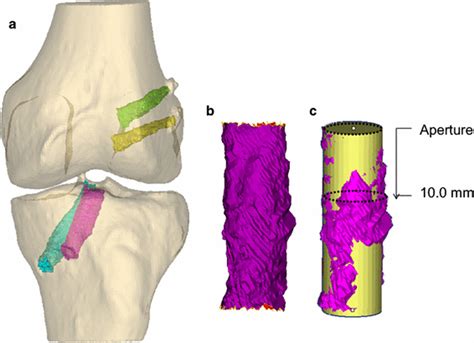 Tunnel Widening In Single‐ Versus Double‐bundle Anterior Cruciate