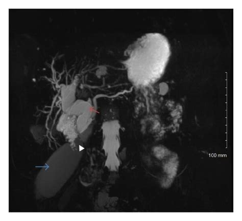 An Mrcp Image Is Shown In A Demonstrating The Type 1c Choledochal Download Scientific