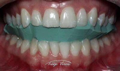 Clareamento Dental Dentista Em Londrina Dr Tiago Veras