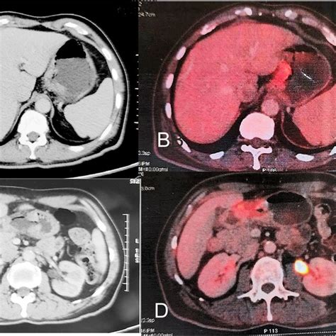 Contrast enhanced computerized tomography and PET scan showing lesions ...