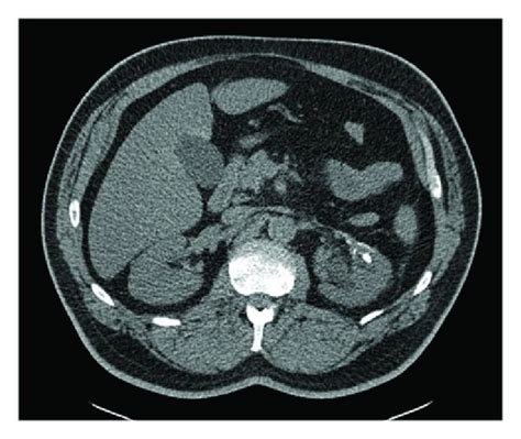 Noncontrast Helical Abdominal Ct Scan Showing Persistent Mm Left