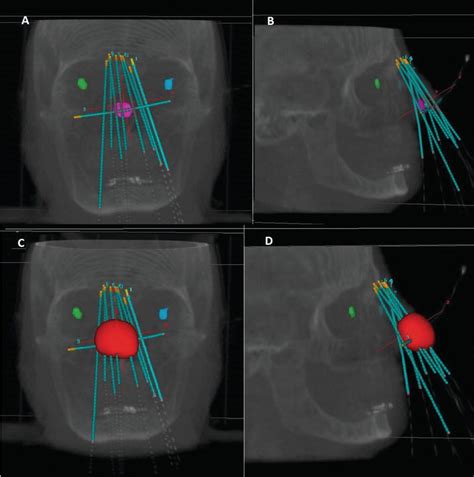 Treatment Planning In Brachytherapy Hdr Based On Three‐dimensional