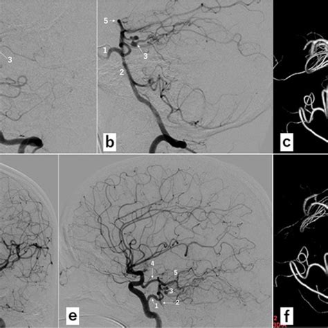 Digital Subtraction Angiography Of The Patient Before A E And After Download Scientific