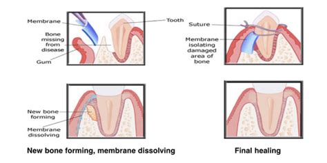 Guided Tissue Regeneration Bone Grafting Membranes Flashcards Quizlet