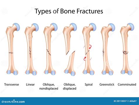 Tipos De Fraturas De Osso Ilustração Do Vetor Ilustração De Osso 28110037