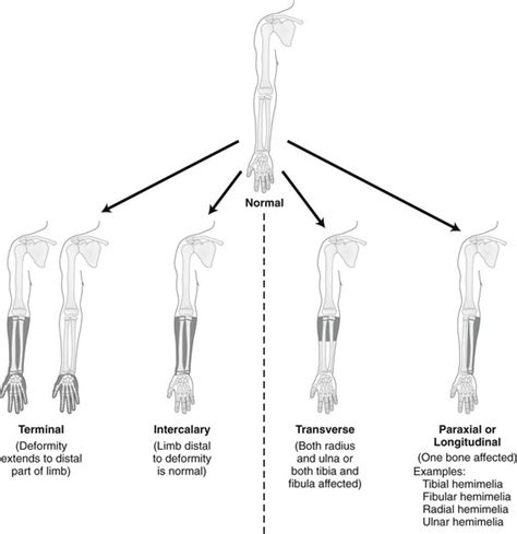 Congenital Anomalies Of Bone Radiology Key