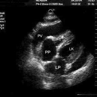 Transthoracic echocardiography in subcostal view showing right ...