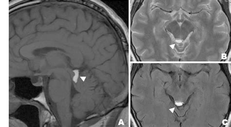 Quadrigeminal Cistern Lipoma