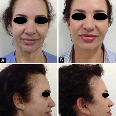 A Preoperative Frontal View B Late Postoperative 6 Months Frontal