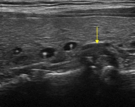 Abdomen and retroperitoneum | 1.6 Gastrointestinal tract : Case 1.6.6 ...