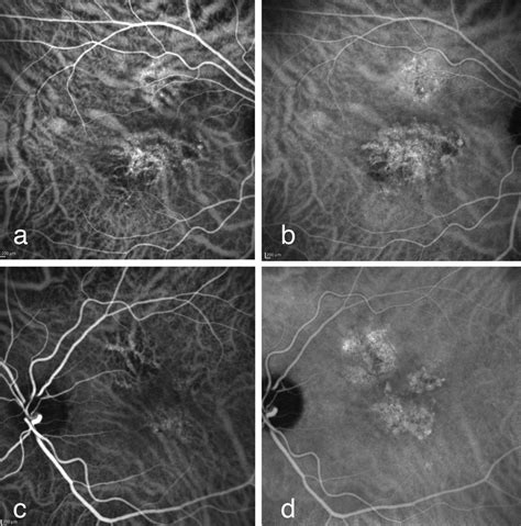 A The Appearance Of Dilated Choroidal Vessels And Hyperfluorescence In Download Scientific