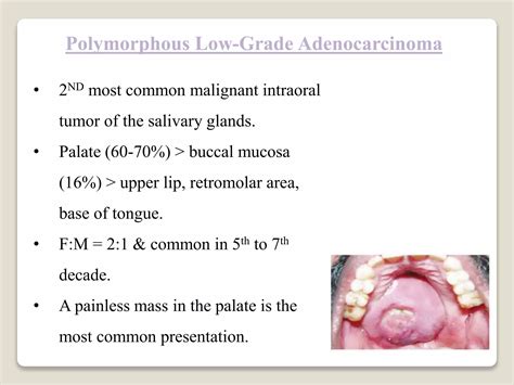 Salivary Gland Tumors Ppt