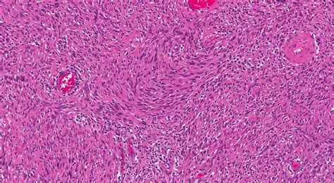 Neoplasia de células fusiformes MyPathologyReport ca