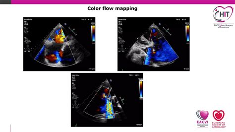 How To Echo Tricuspid Regurgitation Ppt