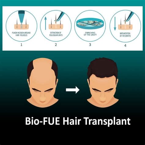 Best Hair Transplant In Mysore View Results Reniu Clinic