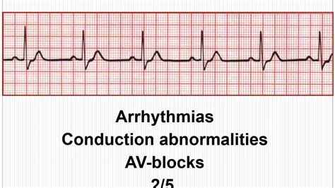 Ecg Arrhythmias Av Conduction Blocks 2 5 Youtube