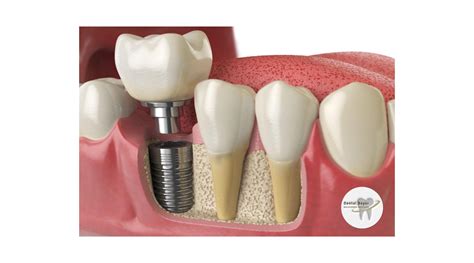 Complicaciones De Los Implantes Dentales Cu Les Son Las M S