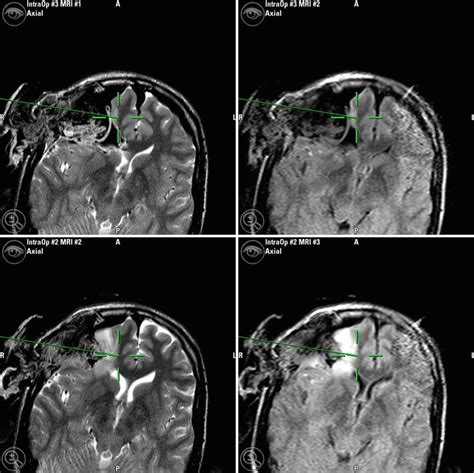 Brain Shift And Updated Intraoperative Navigation With Intraoperative