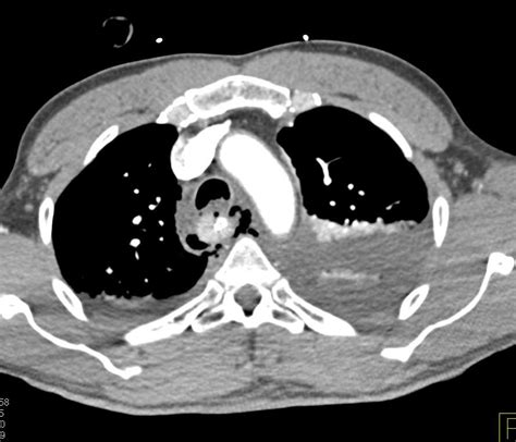 Esophageal Perforation Ctisuscom Case Study Radiology Medical Images