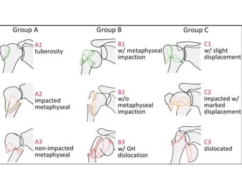 Proximal Humeral Fracture Classification