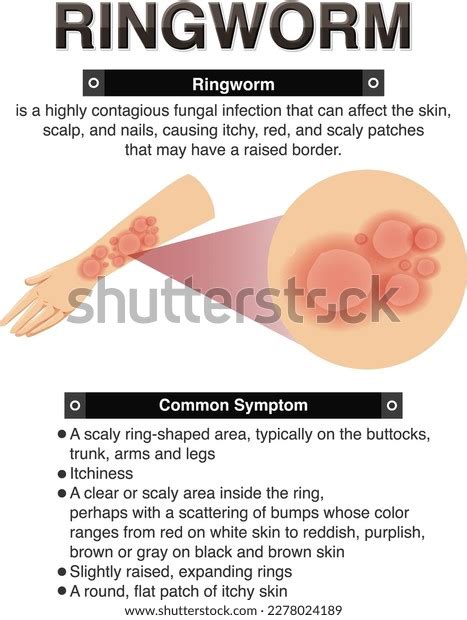 Informative Symptoms Ringworm Illustration Stock Vector (Royalty Free ...