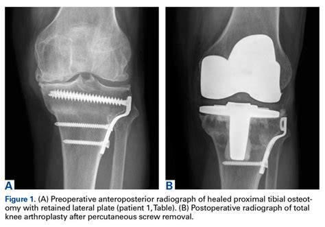 Total Knee Arthroplasty With Retained Tibial Implants The Role Of