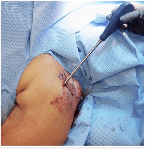 Intraoperative Photo Revealing Placement Of The Reduction Device