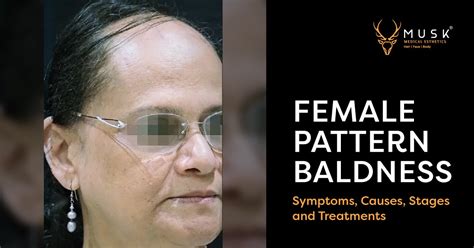 Female Pattern Baldness Symptoms Causes Stages And Treatments