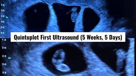 Our First Ultrasound At 5 Weeks And 5 Days It S Five Finding Out We Were Having Quintuplets