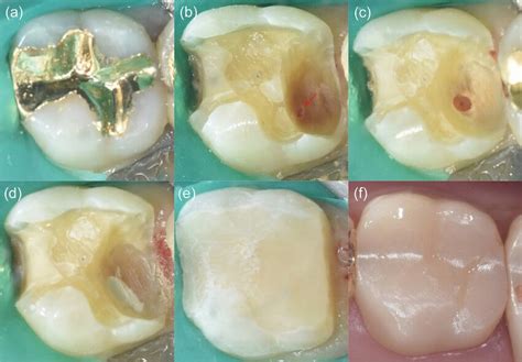 Clinical Protocol For Partial Pulpotomy A Preoperative Clinical