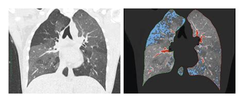 Automatic Detection Of Lung Borders And Lung Parenchyma Blue Areas